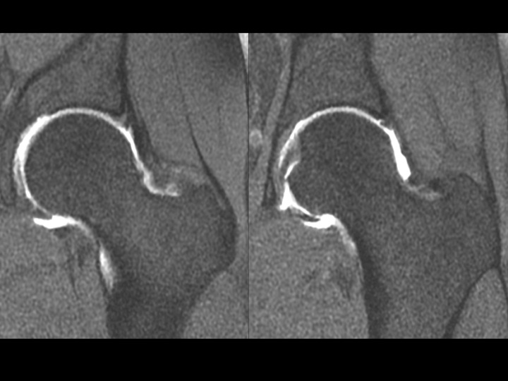 Figure 3 for case subspine impingement